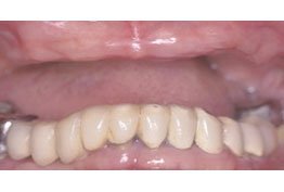Crowns Dentures Implants North Seattle WA Best Top Affordable Family Dentist