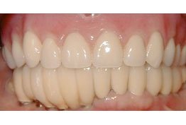 Crowns Dentures Implants North Seattle WA Best Top Affordable Family Dentist